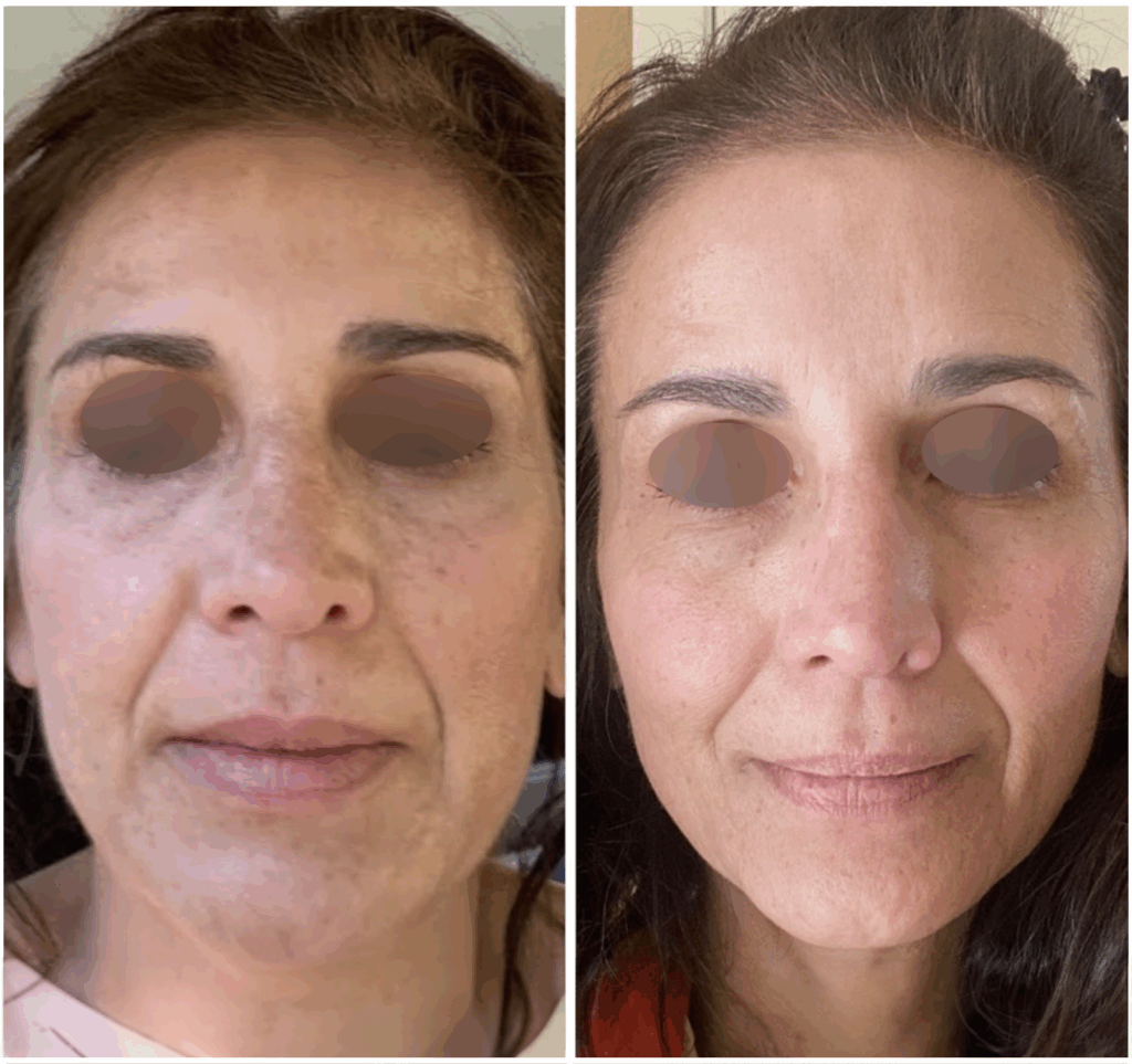 morpheus8 face before after